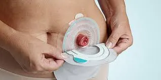 Stoma भएपछि घरमै कसरी हेरचाह गर्ने?
